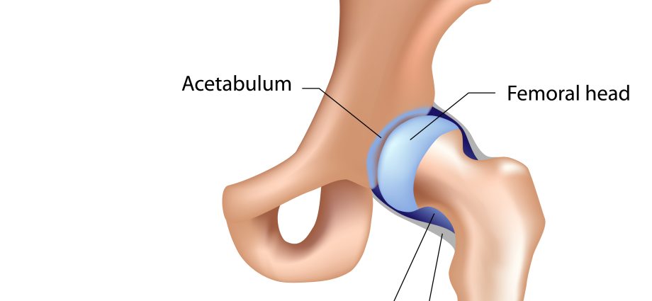 Coxarthrosis of the hip joint