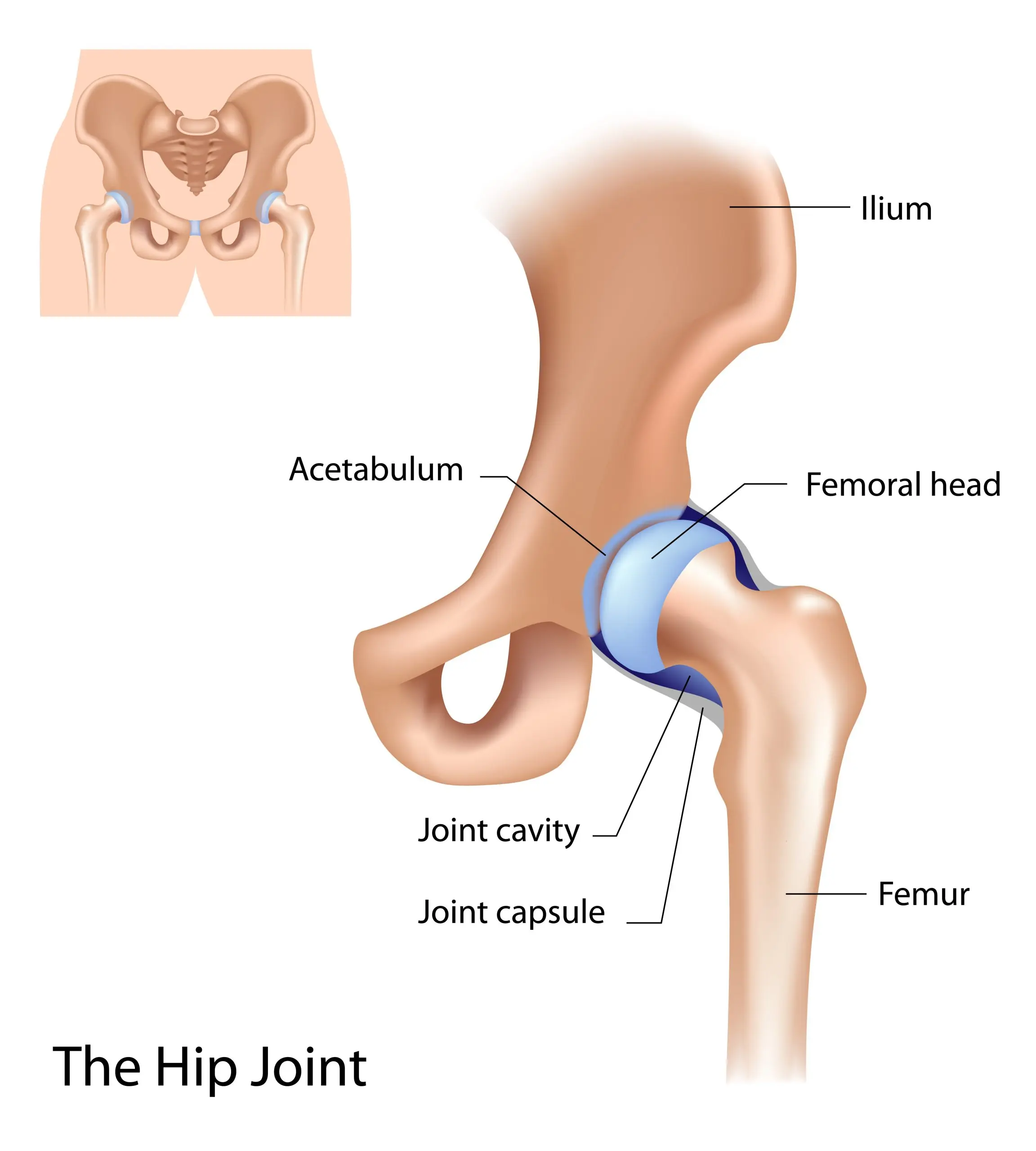 Coxarthrosis of the hip joint