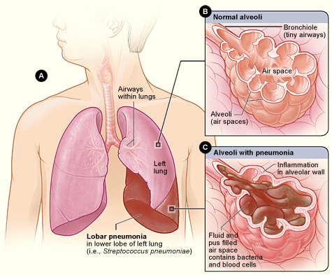 Croupous pneumonia in adults