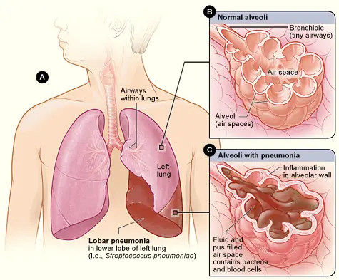 Croupous pneumonia in adults