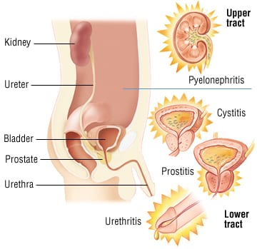 cystitis in men