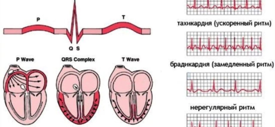 Брадикардия сердца у взрослых