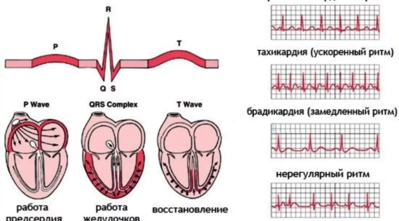 Брадикардия сердца у взрослых