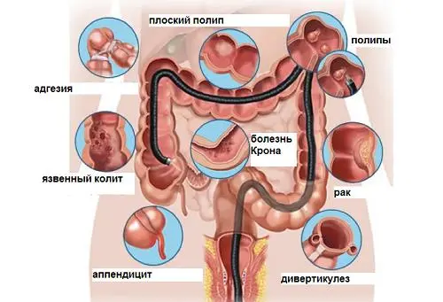 Колоноскопия кишечника