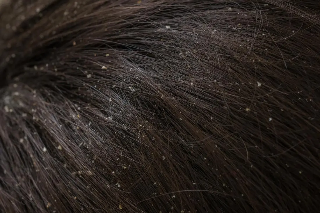 Dandruff on the head