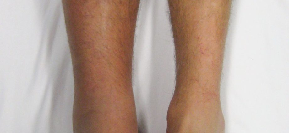 Deep vein thrombosis of the lower extremities