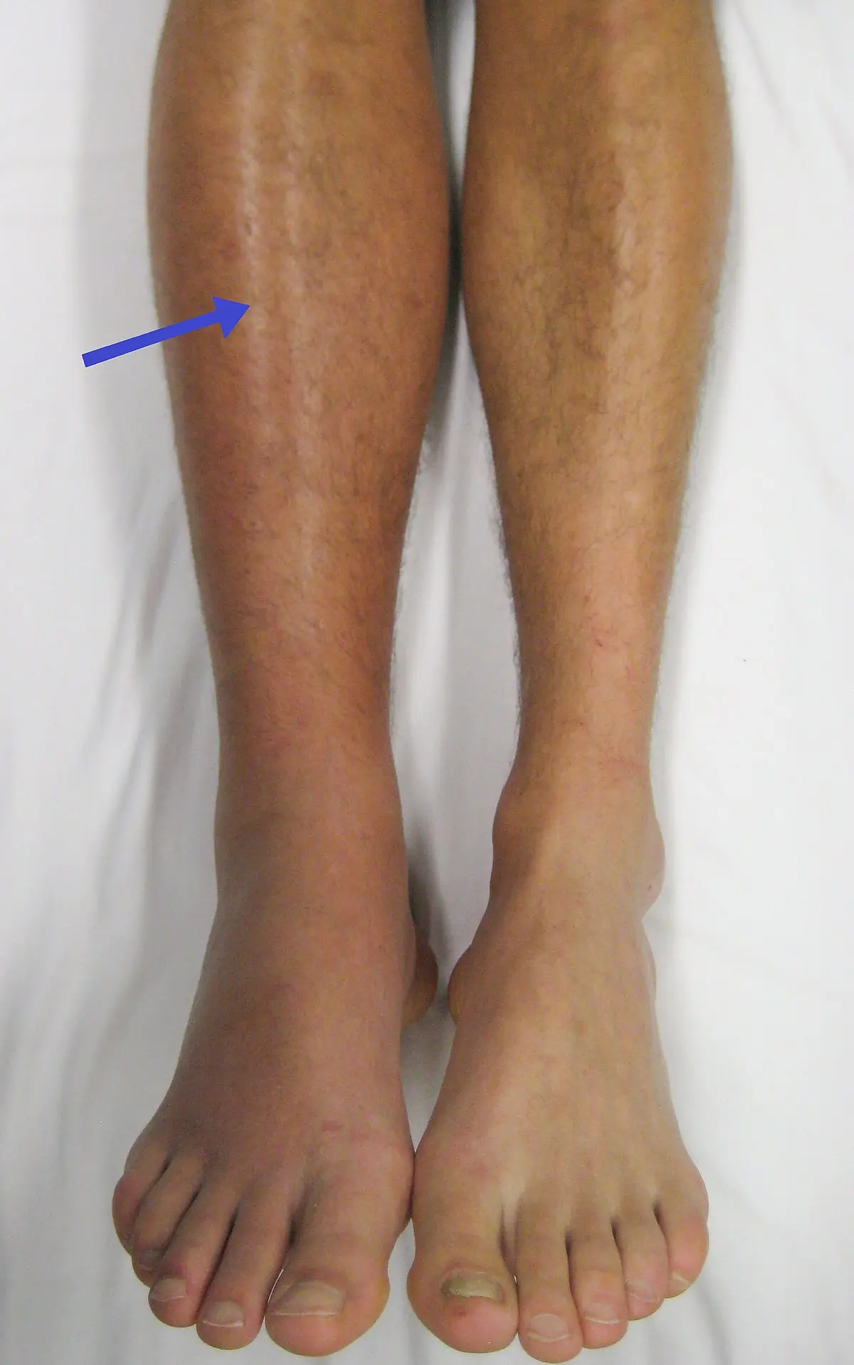 Deep vein thrombosis of the lower extremities