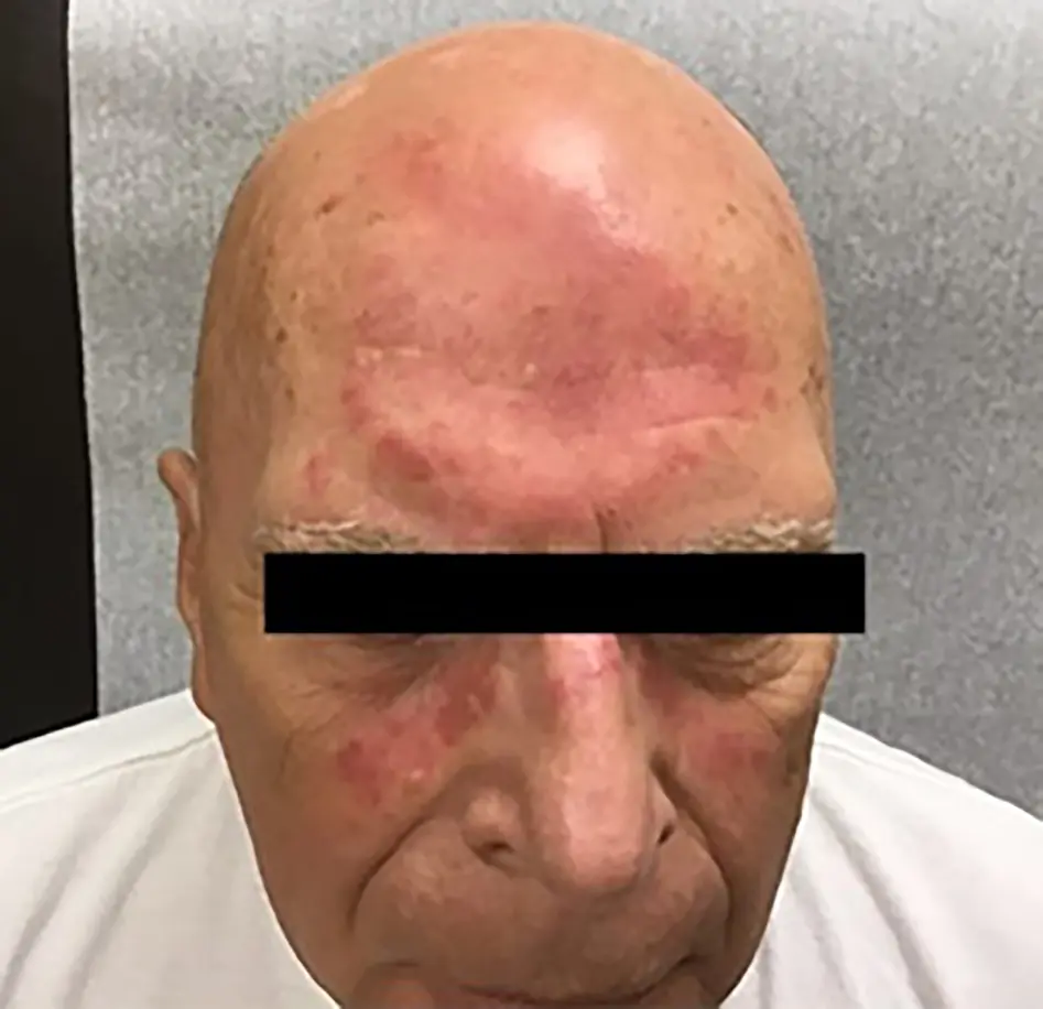 Demodicosis on a man&#8217;s face