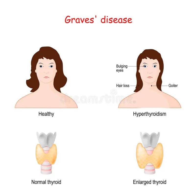 Diffuse toxic goiter in adults