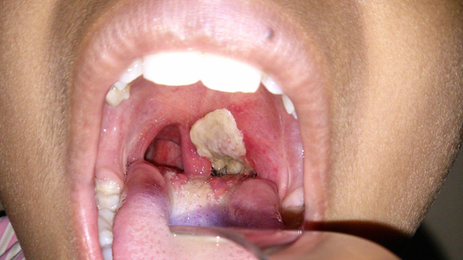 Diphtheria in adults