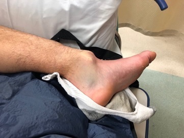 Dislocated ankle