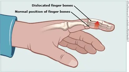 Dislocation of a finger