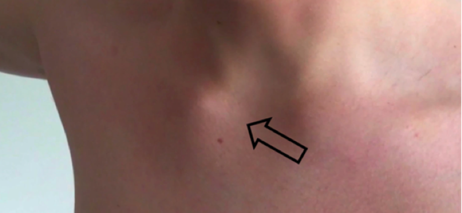 Dislocation of the collarbone