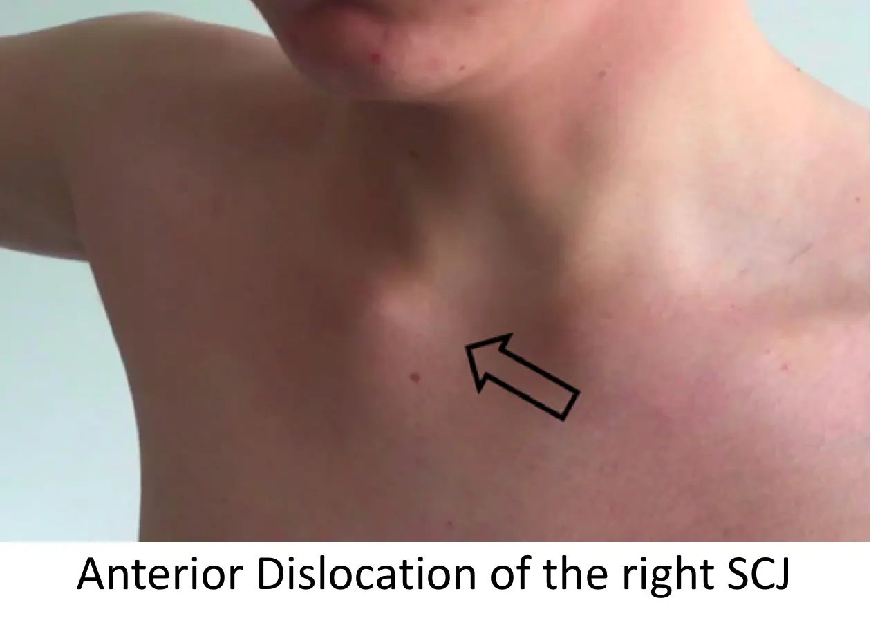 Dislocation of the collarbone