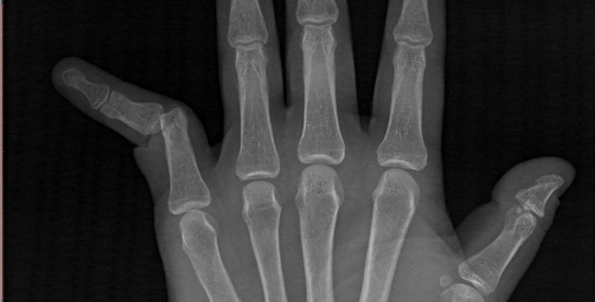 Dislocation of the hand