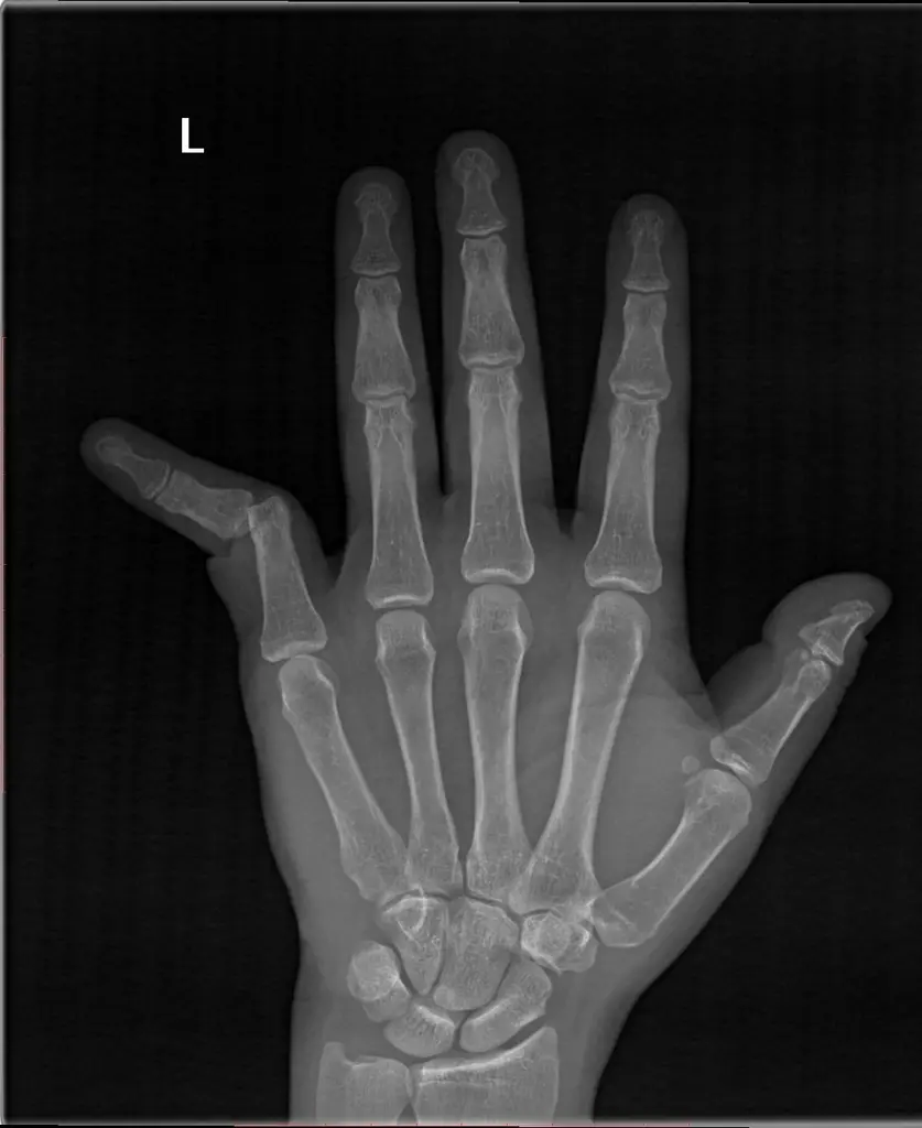 Dislocation of the hand
