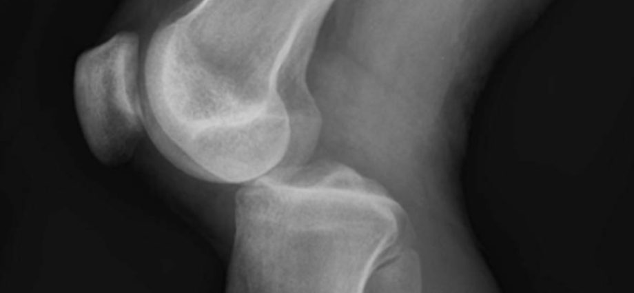 Dislocation of the knee joint