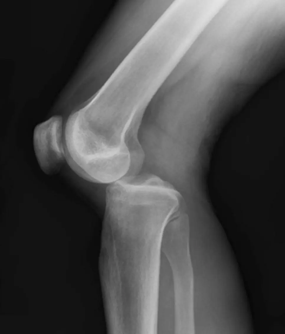 Dislocation of the knee joint