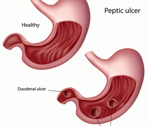 duodenal ulcer in adults