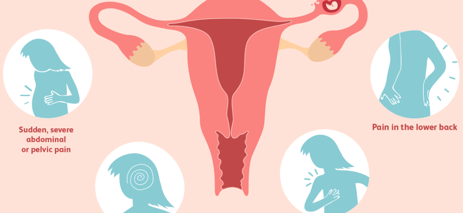 Ectopic pregnancy in the early stages