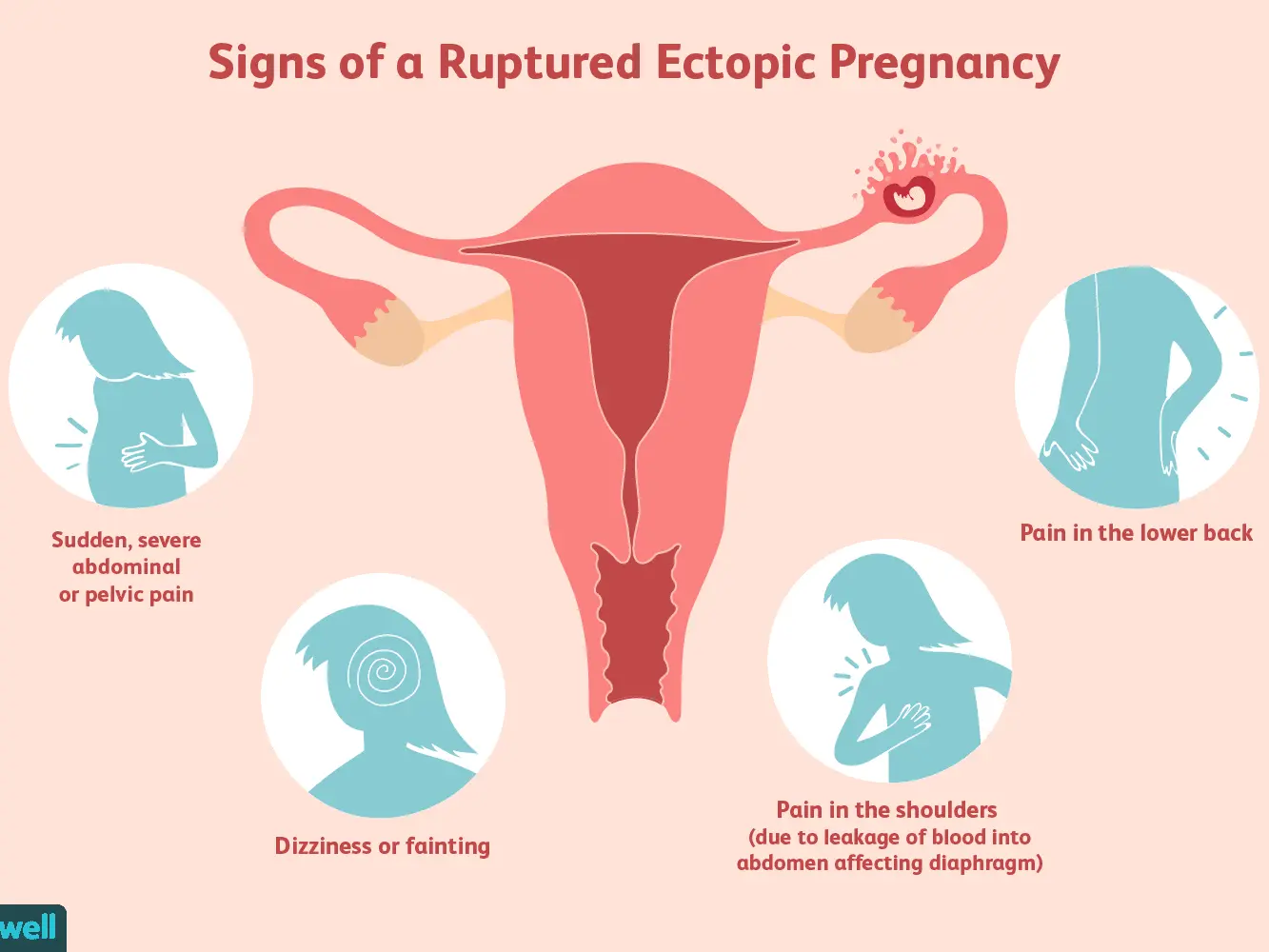 Ectopic pregnancy in the early stages
