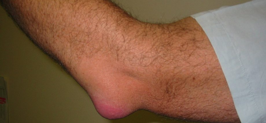 Elbow bursitis in adults