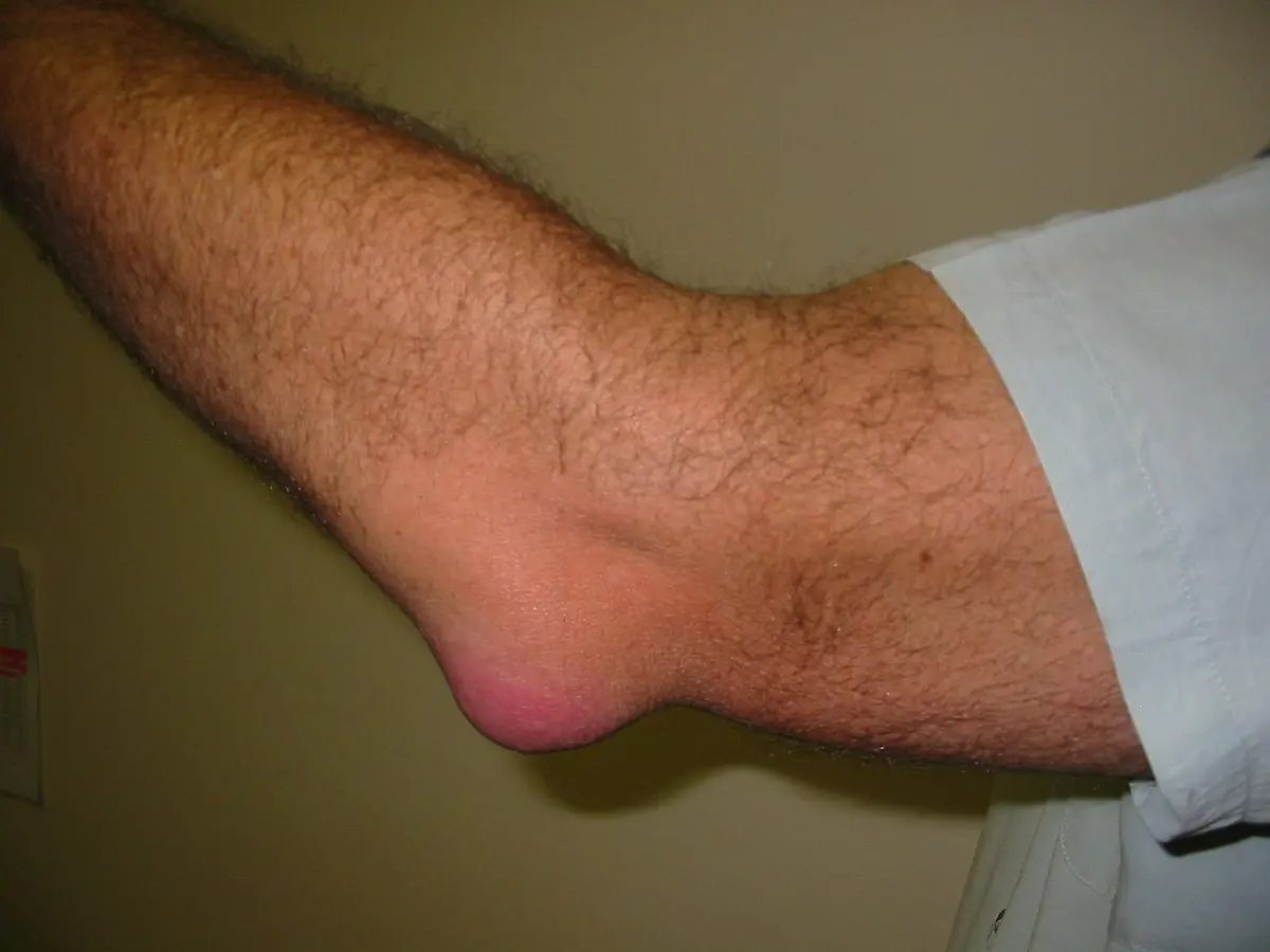 Elbow bursitis in adults