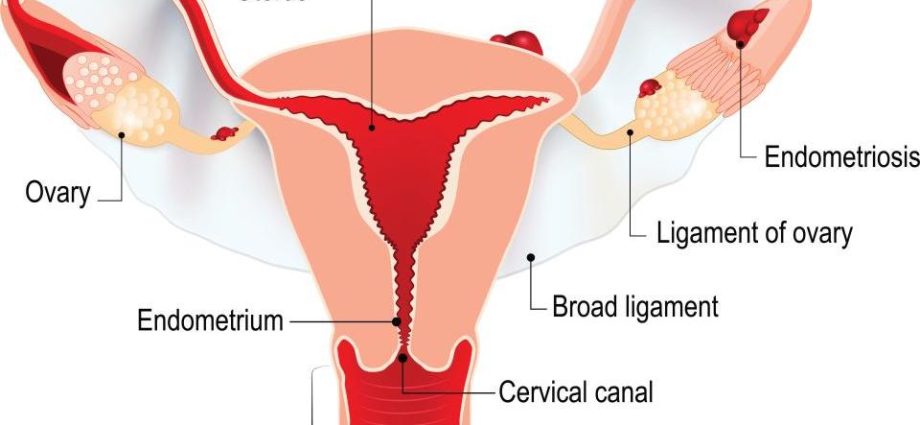 Endometriosis of the cervix in women