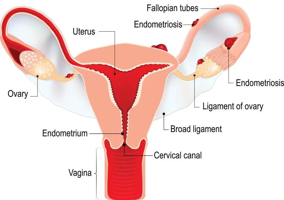 Endometriosis of the cervix in women