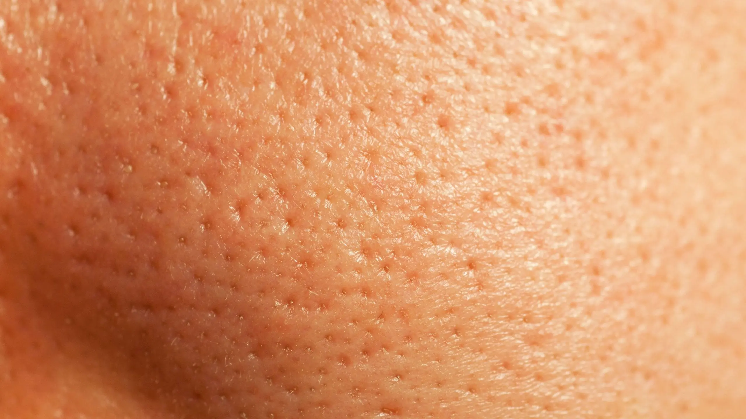 Enlarged pores on the face