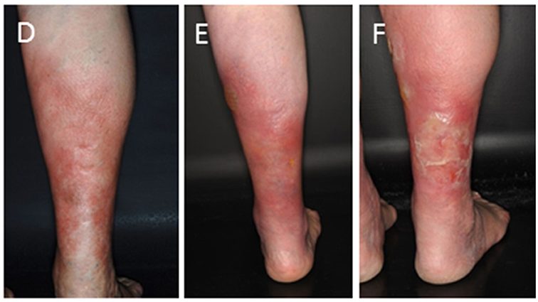 Erysipelas in adults