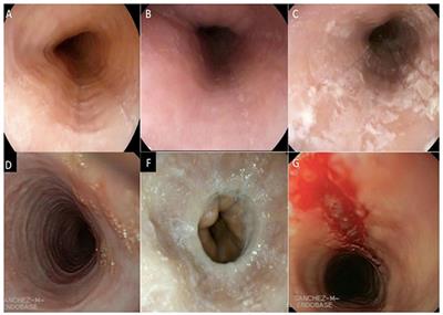 Esophagitis in adults