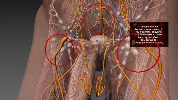 Exacerbation of chronic prostatitis in men