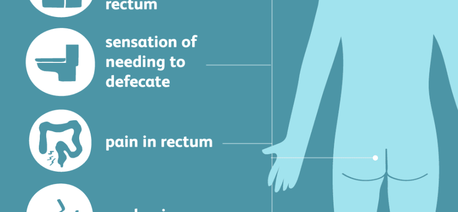 External hemorrhoids in men