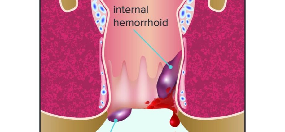 External hemorrhoids in women