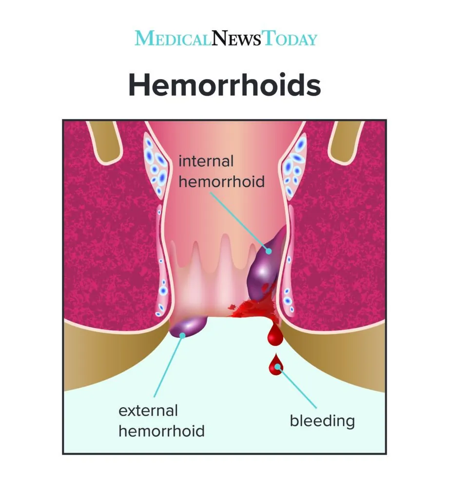 External hemorrhoids in women