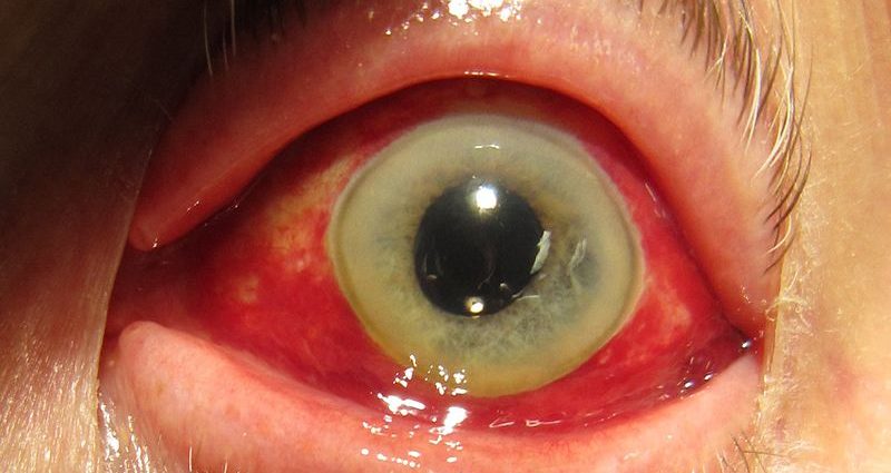 Eye hematoma