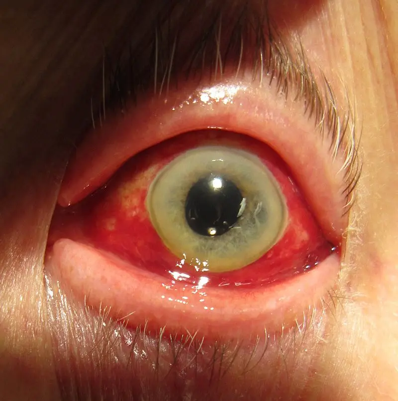 Eye hematoma