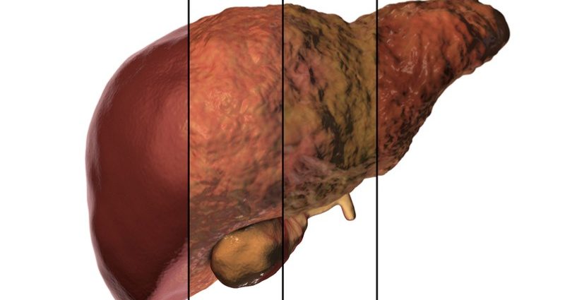 Fibrosis of the liver