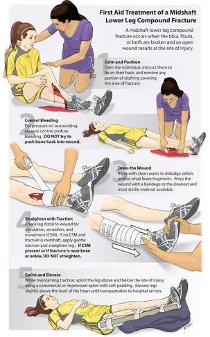 First aid for fractures