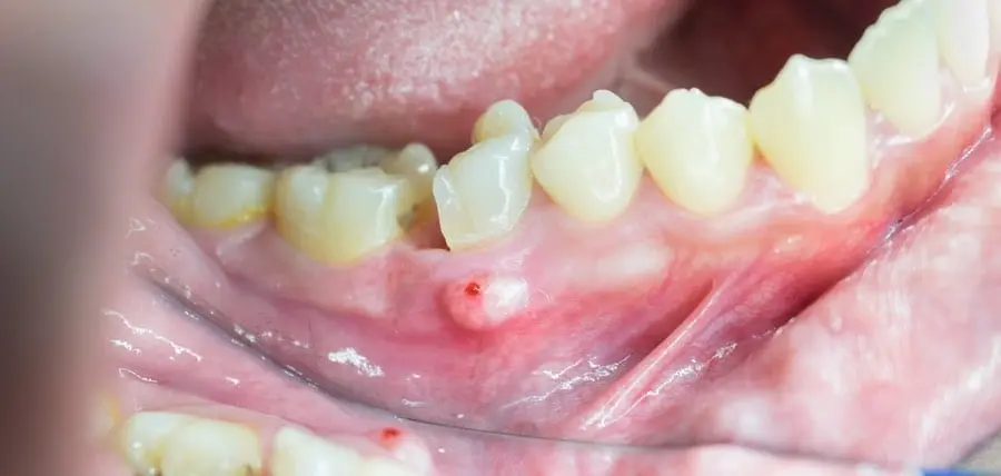 Fistula on the gums in adults