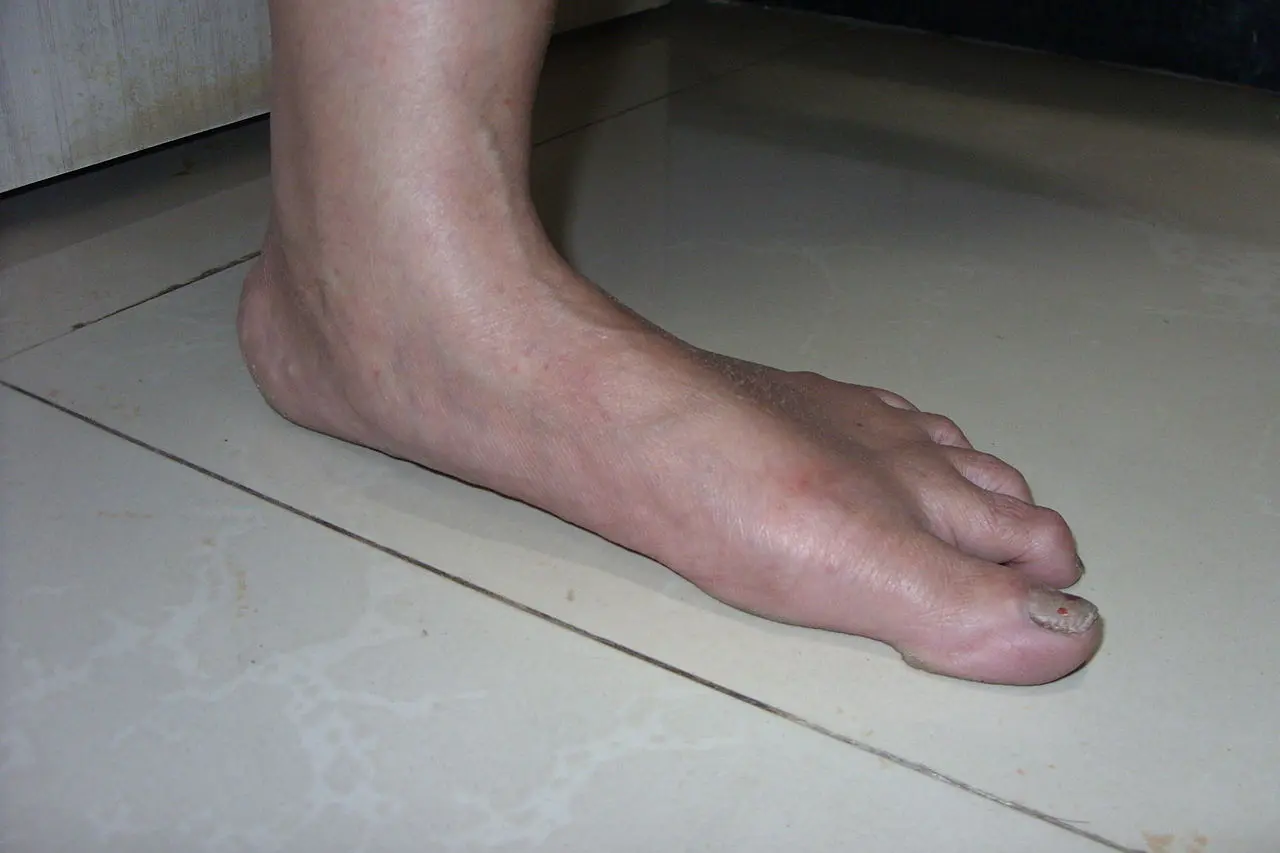 Flat feet in adults