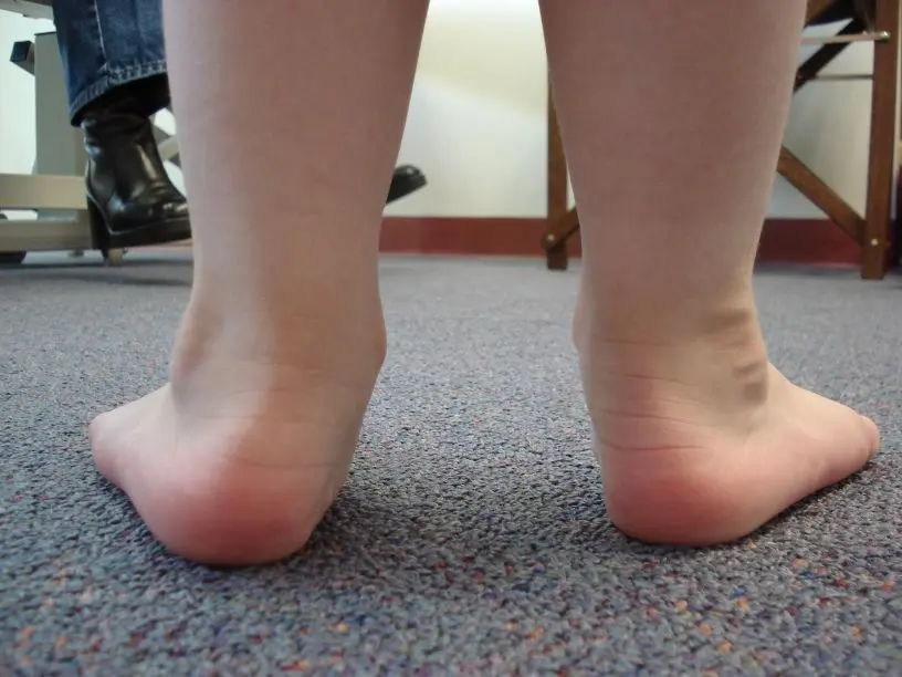 Flat feet in children