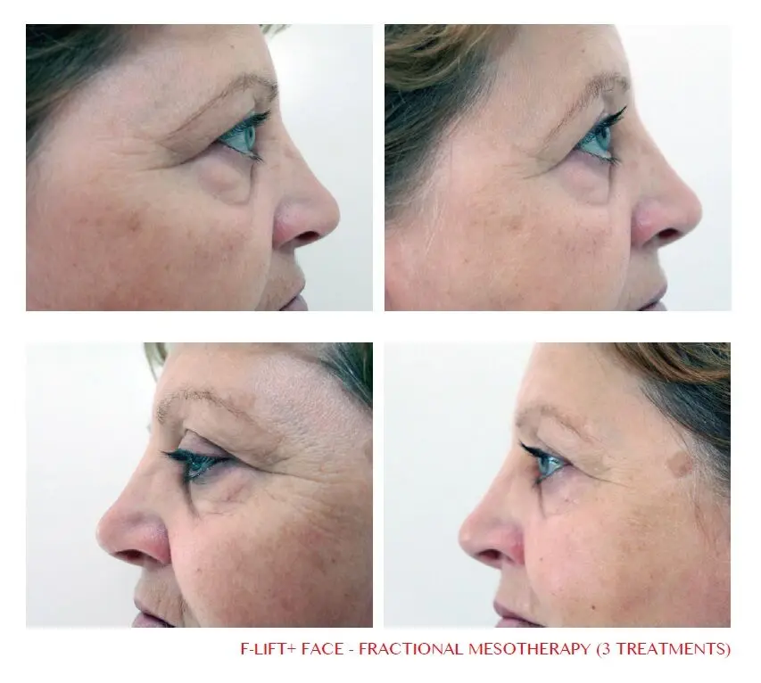 Fractional mesotherapy faces