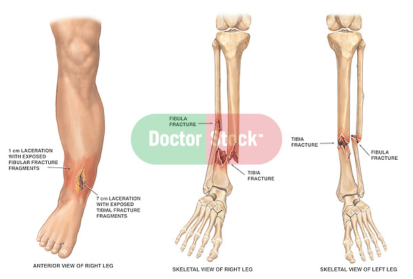 Fracture of the lower leg