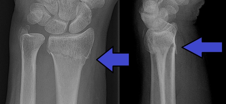 Fracture of the radius