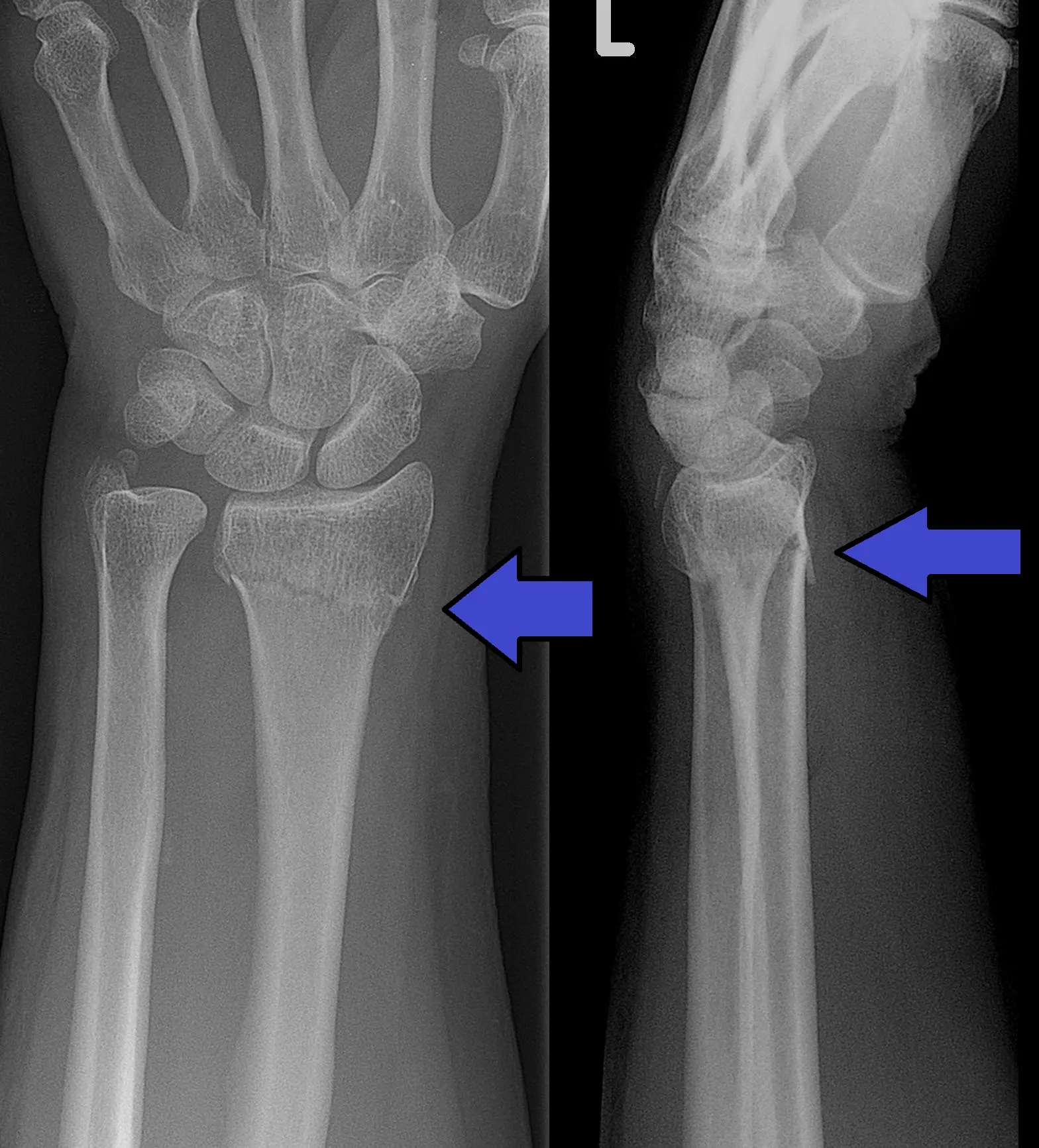 Fracture of the radius