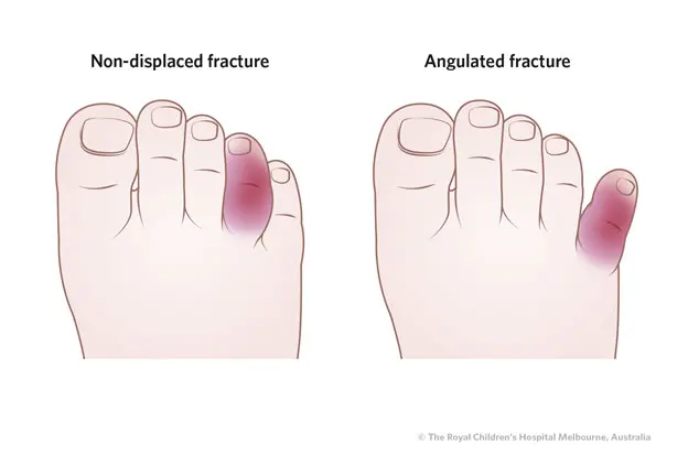 Fractured toe