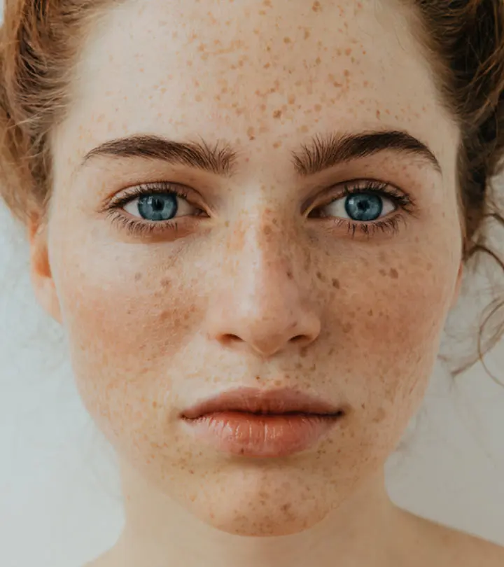 Freckles on the face