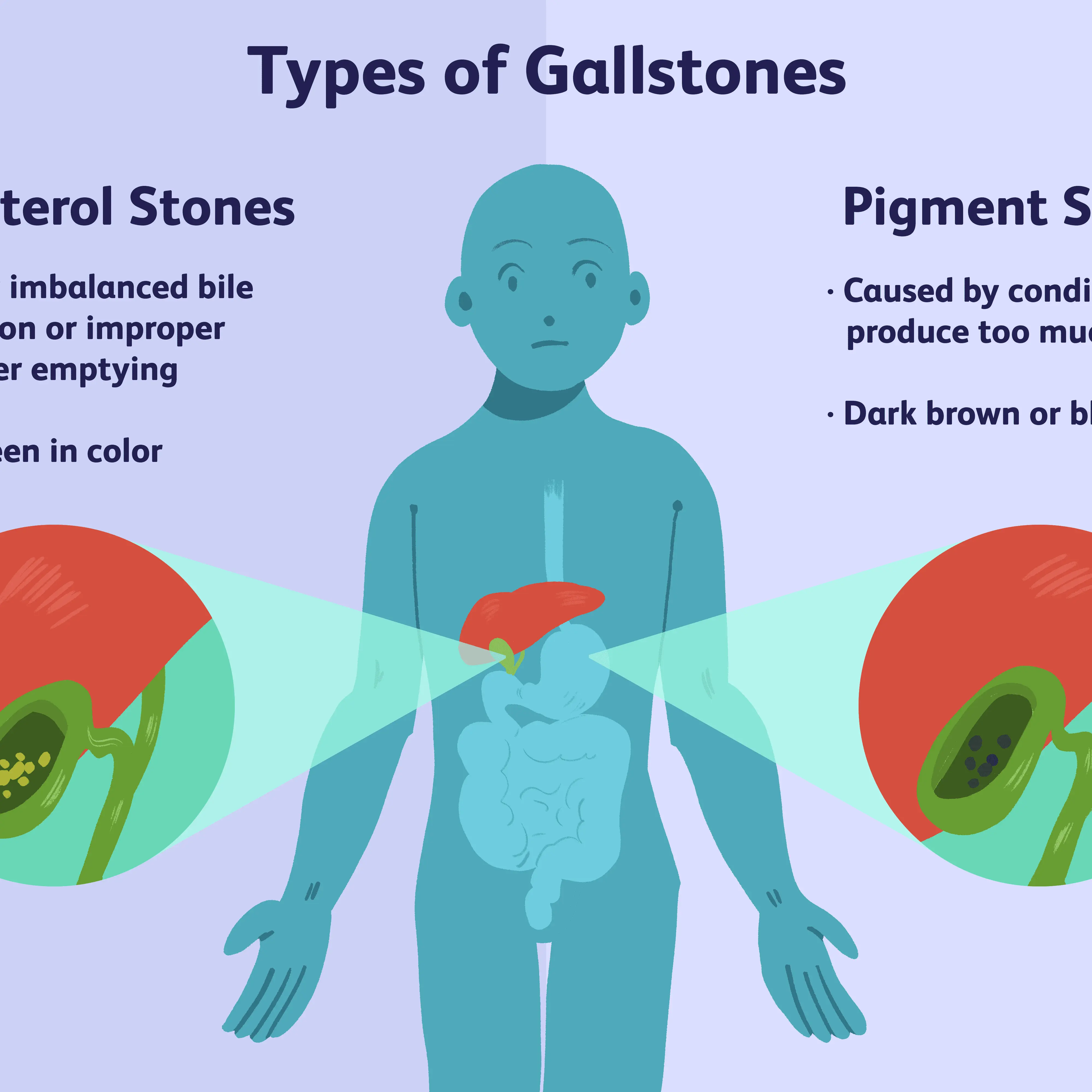 gallstone disease in adults